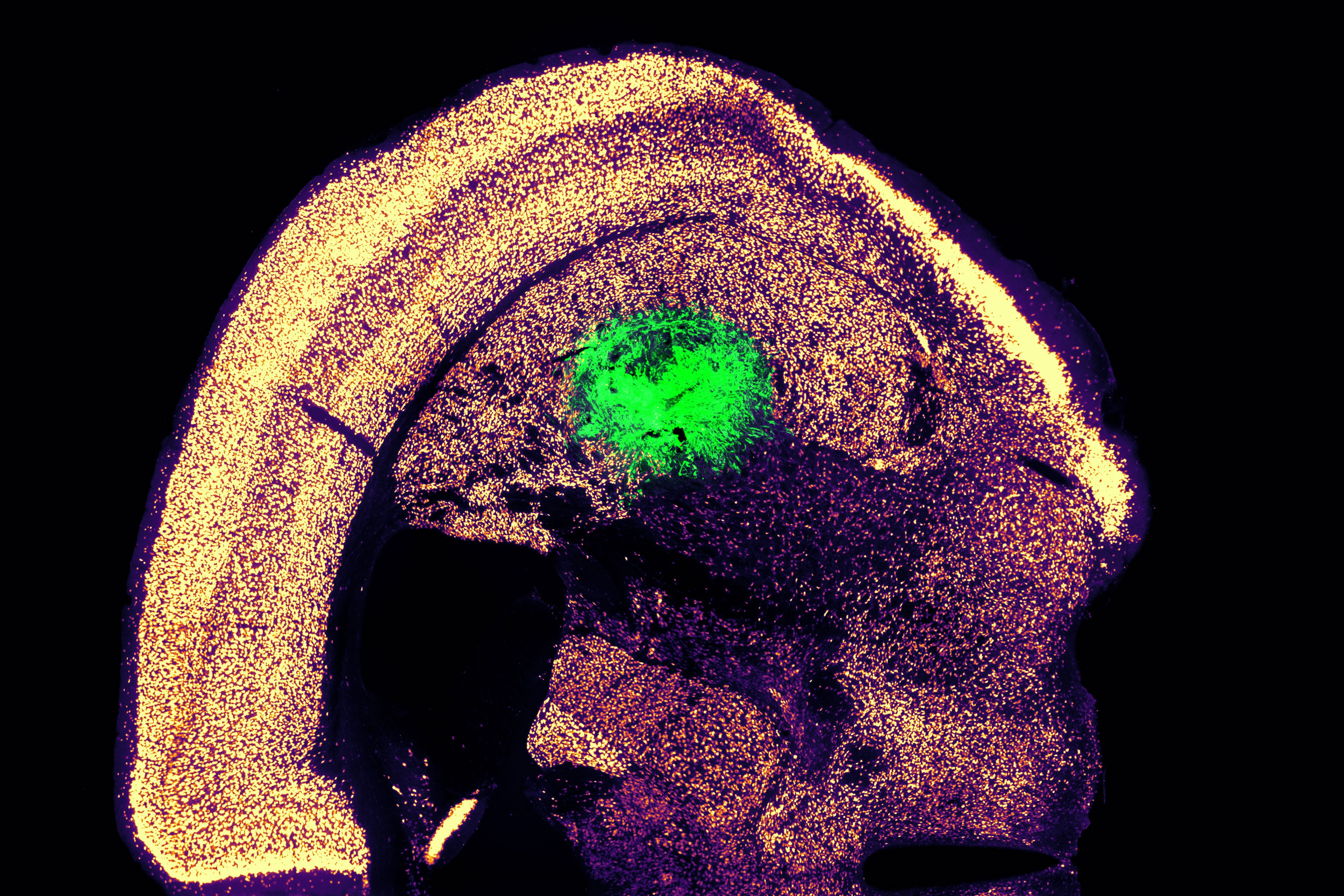MIT engineers turn skin cells directly into neurons for cell therapy