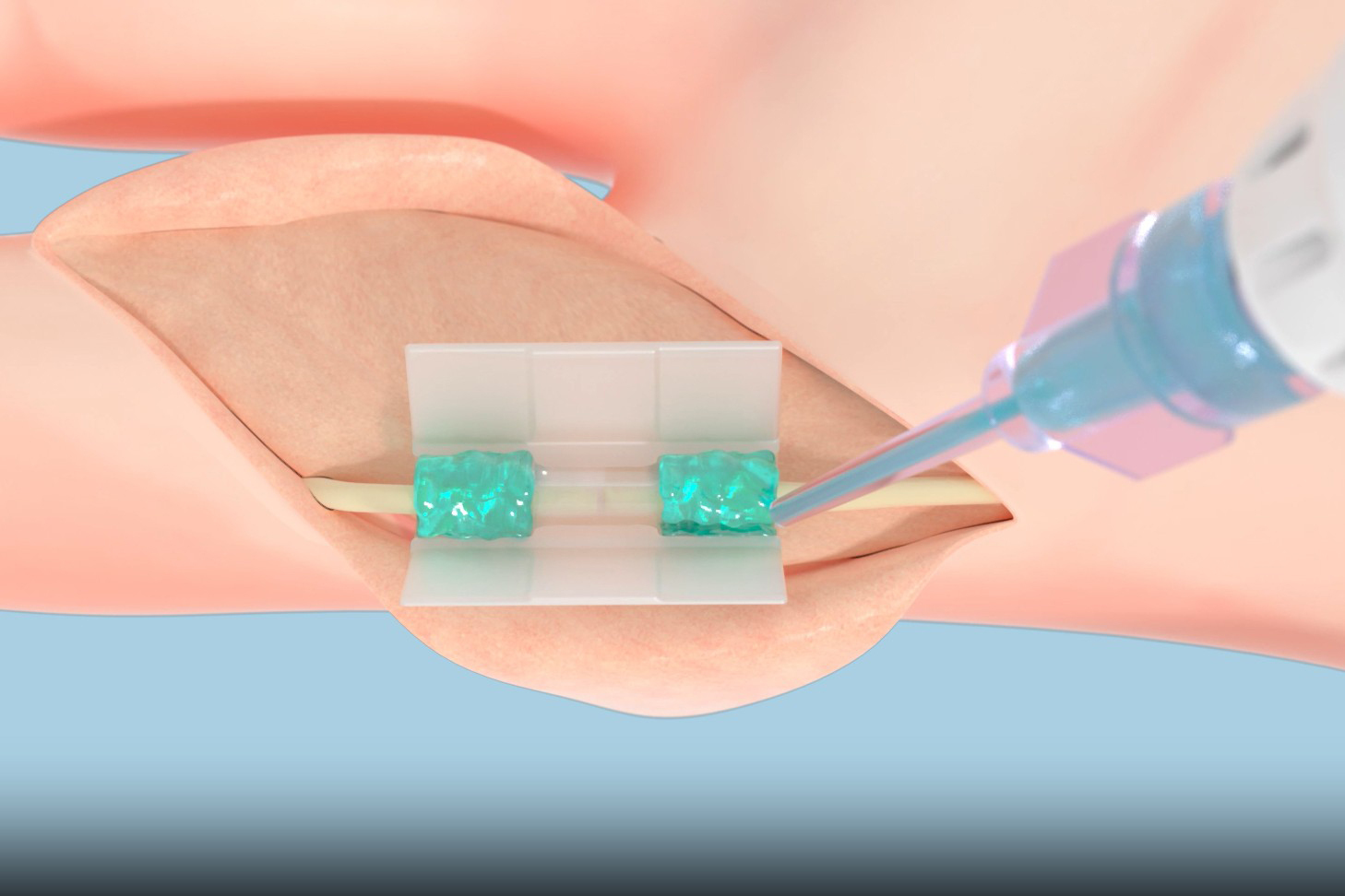 Ushering in a new era of suture-free tissue reconstruction for better healing