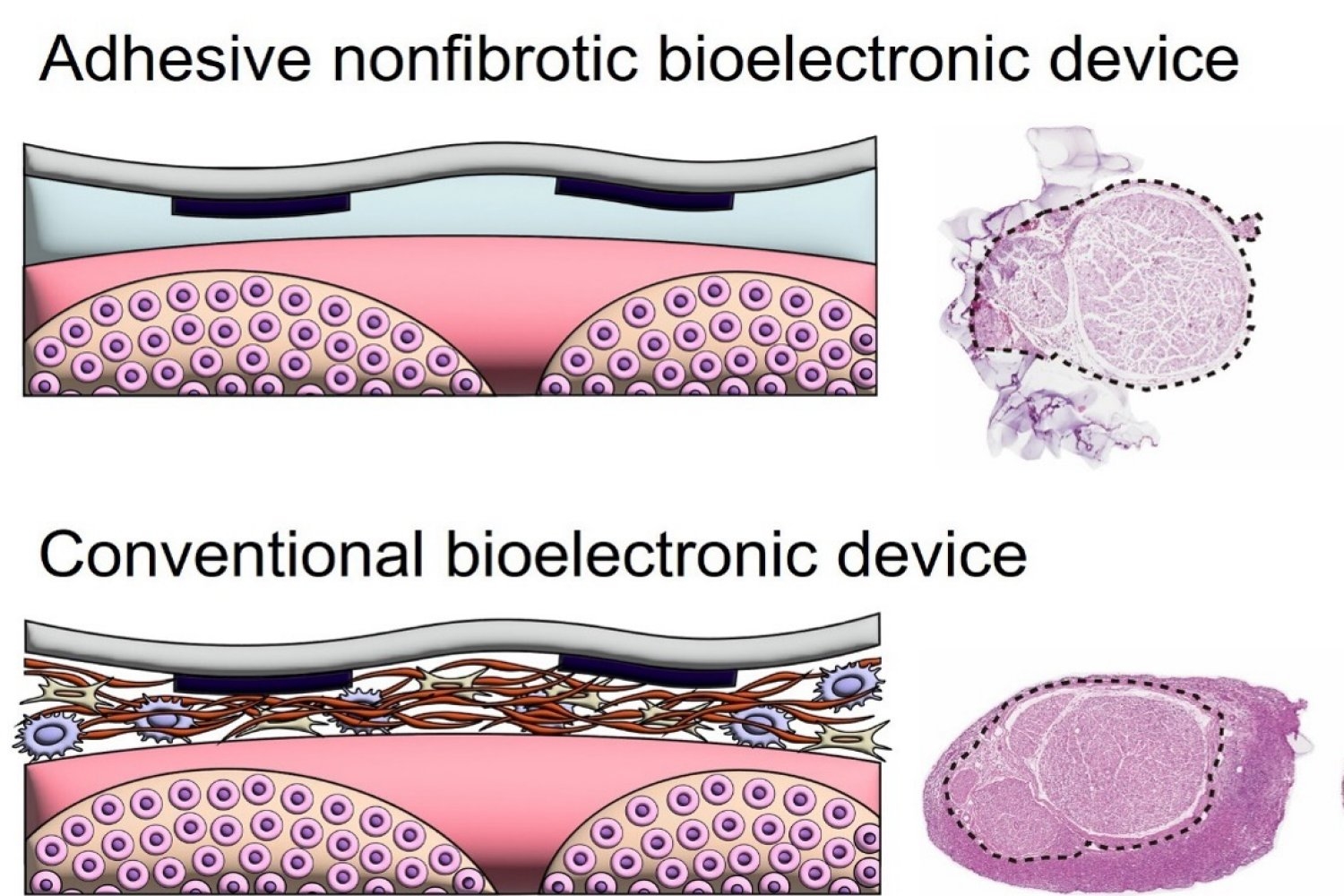 New bioadhesive strategy can prevent fibrous encapsulation around device implants on peripheral nerves