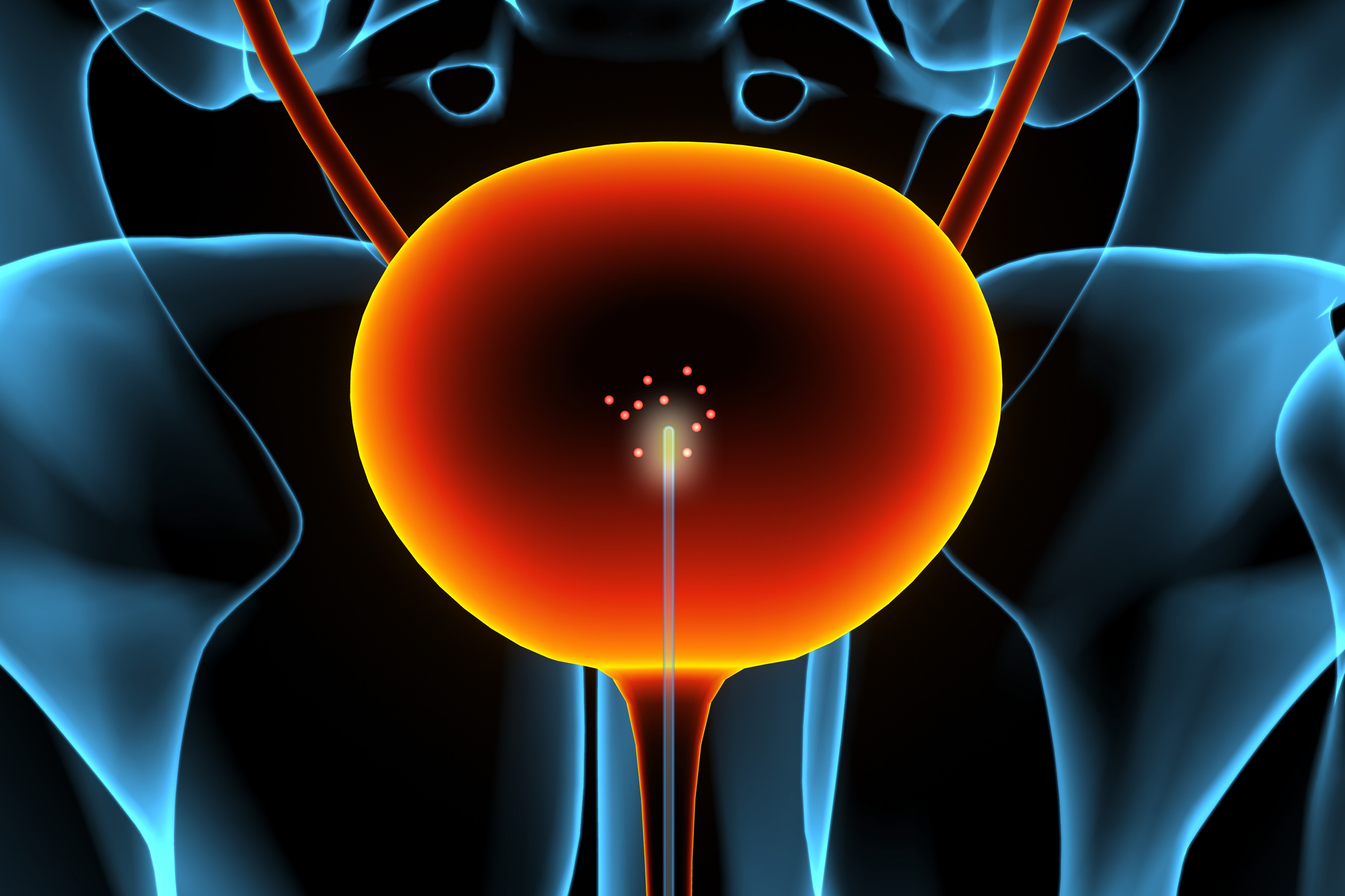A new sensor could enable earlier detection of bladder cancer