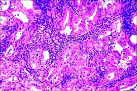 Ovarian cancer cells can be seen infiltrating the outer layer of the ovary in the mouse model of ovarian cancer.