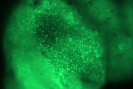 Green fluorescent mesenchymal stem cells in a primary tumor. These cells may be responsible for metastasis in a significant subset of breast cancer patients.