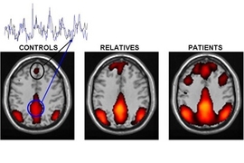 Altered brain connectivity of default brain network in persons with schizophrenia...