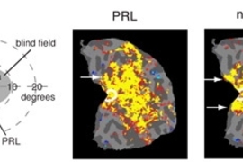 Left: A macular degeneration patient suffers vision loss in the central visual field of the retina (fovea) and uses a new fixation (PRL, preferred retinal locus) in the lower periphery for tasks such as reading. Visual stimuli were presented at the PRL and another peripheral location (nonPRL).

Middle and Right (fMRI scans): Central vision cortex (white circle) responds to both stimuli presented a...