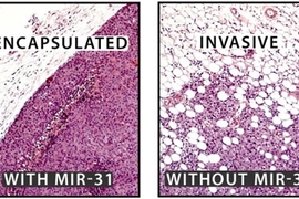 In mice, the loss of microRNA miR-31 allows cancer cells to spread to the lungs more easily than cancer cells with miR-31. The edge of the cancer tumors lacking miR-31 are also less defined than tumors containing cells with higher levels of miR-31.