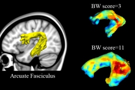 On the left, the arcuate fasciculus is highlighted in the brain. On the right, the colors of the arcuate fasciculus indicate the level of randomness of water diffusion within the structure, which reflects the integrity of white matter tracts and fiber organization. Higher fractional anisotropy (FA) scores indicate higher tract integrity. The MIT team found that those values correlated with scores ...