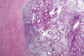A micrograph showing endometriosis (right) and ovarian stroma (left).