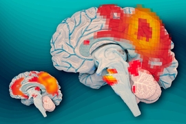 At left, the brains of adults who had ADHD as children but no longer have it show synchronous activity between the posterior cingulate cortex (the larger red region) and the medial prefrontal cortex (smaller red region). At right, the brains of adults who continue to experience ADHD do not show this synchronous activity.