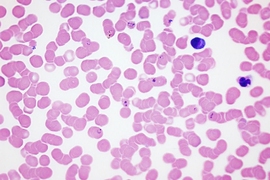 Red blood cells from a patient infected with Plasmodium falciparum.