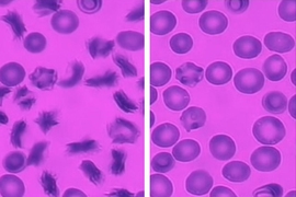 As red blood cells from sickle cell patients flow through the new MIT microfluidic device, many of them become sickled following exposure to a low-oxygen environment (left). At right, when oxygen levels are restored, the cells resume their normal shape.