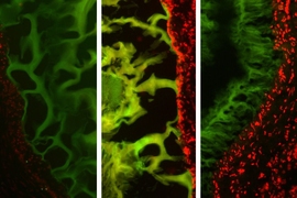 MIT researchers tested their tissue adhesive in three types of tissue: (left to right) healthy colon tissue, colon tissue inflamed with colitis, and cancerous colon tissue. The tissue is shown in red, and the adhesive material is green.