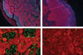 The top two panels show tumors produced by cancer cells. The outer ring of cells (blue) has enough oxygen to survive, but not as much oxygen reaches the inner cells. At top right, tumor cells lack the SHMT2 gene and are unable to survive in this central region, as indicated by the pink stain that marks a protein produced during cell death. At top left, the cells express high levels of SHMT2, allow...