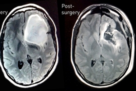 MRI data showing Keating’s astrocytoma tumor before and after surgical removal.