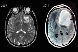 MRI data showing Keating’s astrocytoma tumor growth between 2007 and 2014.