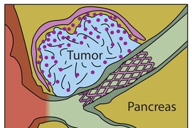 MIT researchers have designed a drug-delivering material that could be used to coat stents, helping the bile duct to remain clear in patients with pancreatic cancer.

