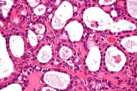 A high-magnification micrograph of an ovarian clear cell carcinoma. The images show, focally, the characteristic clear cells with prominent nucleoli and the typical hyaline globules.