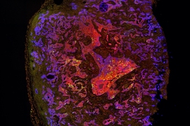 MIT researchers have found that lung tumors such as this one contain stem-cell-like cells that drive tumor aggression. In this image, those cells are tagged with a green fluorescent protein. 
