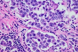 MIT researchers are working on an implantable device that could make intraperitoneal chemotherapy more bearable. “As we entered into this project, our question was how do we get the same beneficial outcomes and reduce all the side effects?” says professor Michael Cima. Pictured is a micrograph of ovarian cancer. 

