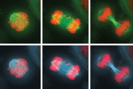 Chromosome segregation errors lead to abnormal karyotypes, a condition known as aneuploidy. Shown here is a cell undergoing cell division and experiencing chromosome mis-segregation.
