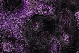 In this image, lung cancer driven by the KRAS oncogene shows up in purple. MIT biologists have found a potential new way to treat this type of lung tumor, long thought to be “undruggable."