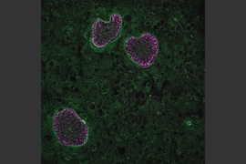 In this image, four Plasmodium vivax parasites have invaded human hepatocytes. Three of the parasites are developing while one parasite, on the lower right, is a dormant hypnozoite, which remains small until its reactivation.
