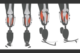 Two agonist-antagonist myoneural interface devices (AMIs) were surgically created in the patient’s residual limb: One was electrically linked to the robotic ankle joint, and the other to the robotic subtalar joint. 