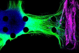 MIT engineers created this model of the neuromuscular junction using motor neurons derived from ALS patients. The motor neurons (blue) send fibers called neurites (green) toward the muscle fibers (pink).