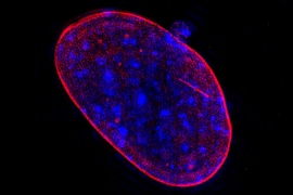 Aneuploid cells, such as this one, have too few or too many chromosomes.  A new study has revealed that highly aneuploid prostate tumors carry a higher risk of lethality.