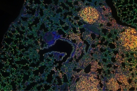 MIT researchers have analyzed how epigenomic modifications change as tumors evolve. This image shows a lung with tumors that researchers collected with multiplexed immunohistochemistry.