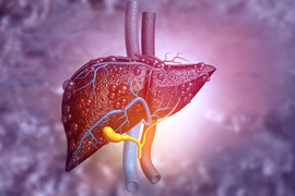 fatty liver disease graphic