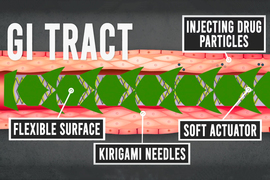 gi tract graphic featuring stent
