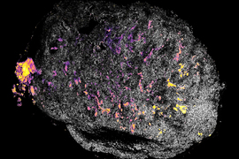 Image of a tumor (white dotted structure against a black background), with patches of pink and yellow dye