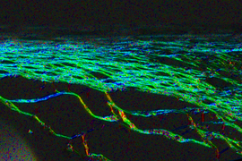 A network of glowing green strands against a black background. The strands, which are scar tissue, are wavy but roughly parallel to each other.