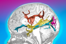 Against a decorative background is a profile view of a person’s brain scan. Overlayed on the brain are 4 brightly colored renderings of late-visual pathways, like stretchy taffy. The renderings stretch across the brain and are tangled in the center.