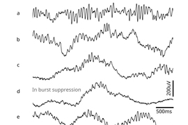 7 examples of brain waves are shown as black lines going from left to right, from a-g. Line (d) has a label that says, “In burst suppression,” and is the most flattened of the wavey lines.
