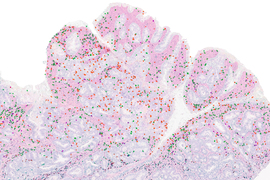 A colon tumor is stained pink and has many tiny dots in green and red. Areas not stained pink have less dots.