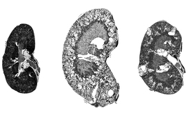 Black-and-white renderings of three kidneys, with the largest one in center