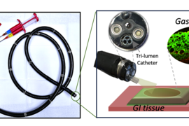 On left, a long endoscope has three syringes of materials going inside of it. On right, the end of the endoscope is enlarged showing the “tri-lumen catheter,” and the material is sprayed onto an illustration of GI tissue. A microscope image enlarges the GI tract, showing a green and red GI tract, labeled “GastroShield.” 