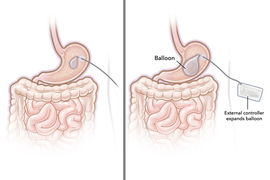 Two images show a stomach with a balloon inside, and it expands in the second image. A device is labeled “external controller expands balloon.”