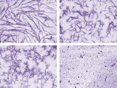 In the upper left, amyloid fibers at first resist any attempt to disrupt their structure. Hsp104, however, breaks them apart until, bottom right, they have been completely dissolved.