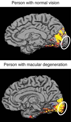 Images of human brains, based directly on data from an MRI machine, show the regions of the brain that are activated by peripheral visual stimuli in a person with normal vision and in a person with macular degeneration. People with macular degeneration lack central vision and must use peripheral vision only. The area at the back of the brain (marked by the white ovals) that normally responds only ...
