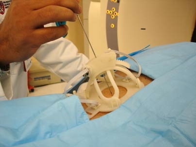 Robopsy, a new invention designed to help doctors do needle biopsies, is shown as it might be positioned for surgery. Robopsy was invented by a team of graduate students, including two from MIT.