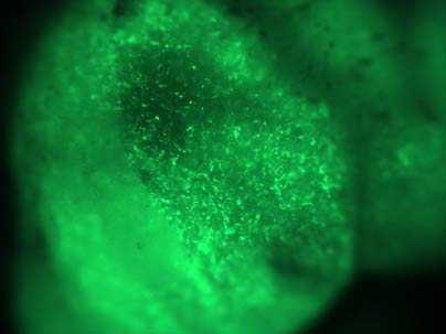 Green fluorescent mesenchymal stem cells in a primary tumor. These cells may be responsible for metastasis in a significant subset of breast cancer patients.