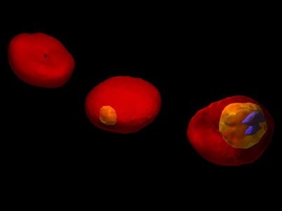3D images of a human red blood cell (RBC) invaded by malaria-inducing parasite Plasmodium falciparum, at different stages of parasite development. The images are based on 3D maps of the refractive index in the cell, recorded by the non-invasive optical technique of Tomographic Phase Microscopy. Healthy RBC exhibits a characteristic biconcave shape (left). During the early stage of parasite maturat...