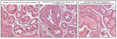 The image on the left shows a sample from a normal prostate, with organized cells lining the O-shaped ductules.  Mice without the PTEN gene had developed cancer, which is characterized by enlarged glands and disorganized cells clogging the ductules (middle image).  When mTORC2 activity is blocked in mice lacking the PTEN gene, the prostate ductules resemble the appearance of norm...