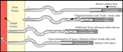 Diagram showing how a new needle developed at MIT works (from top to bottom):
i. Doctor pushes here. 
ii. Filament buckles and 'locks' inside tube. 
iii. Additional force advances entire device.
iv. Upon penetration of space, filament relaxes inside tube and deploys into space.