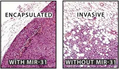In mice, the loss of microRNA miR-31 allows cancer cells to spread to the lungs more easily than cancer cells with miR-31. The edge of the cancer tumors lacking miR-31 are also less defined than tumors containing cells with higher levels of miR-31.