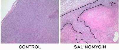 In a comparison of a control to the chemical identified by the Weinberg/Lander team, called salinomycin, the tumor cells (stained dark purple in both slides) were unaffected by the control, but salinomycin killed many tumor cells (stained pink).
