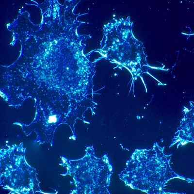 Cancer cells are shown here in culture from human connective tissue, illuminated by darkfield amplified contrast.
