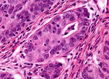 A microscopy image of an ovarian adenocarcinoma. MIT researchers have found a new way to disrupt a protein often overexpressed in ovarian tumors, known as HER3.